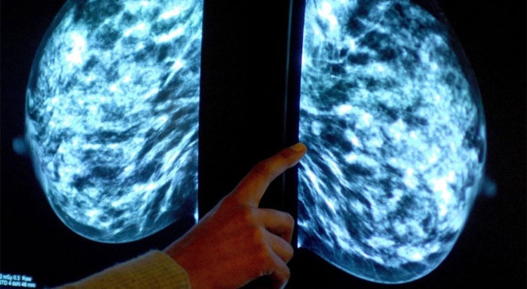 Risk factors for breast cancer - Hormone replacement therapy