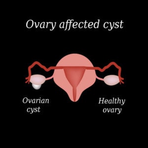 Ovarian Cyst Symptoms, Menopause Center Los Angeles