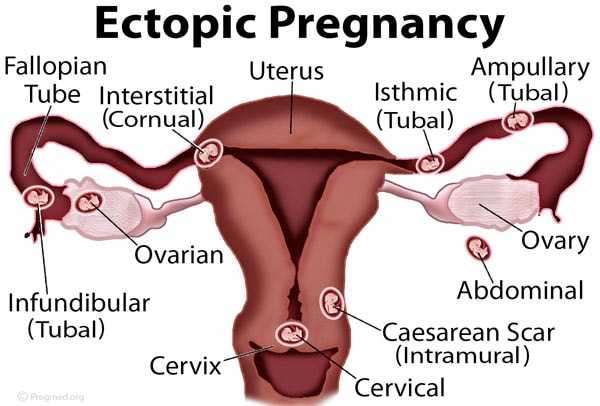 ectopic pregnancy