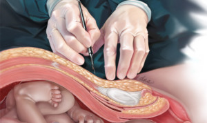 cesarean delivery