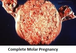 molar pregnancy