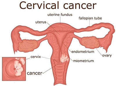 It's Cervical Cancer Awareness Month. Here's What You Nee