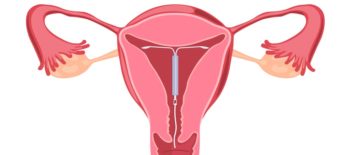 IUDs for Contraception