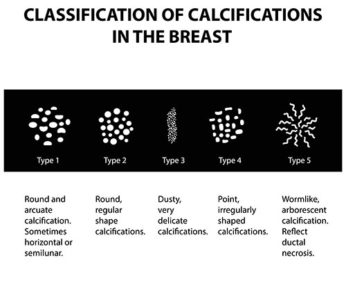 Examples of Breast Calcifications