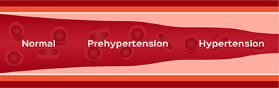 Depiction of narrowing artery - hypertension