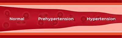 Depiction of narrowing artery - hypertension