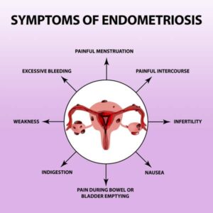 Illustrated diagram of endometriosis symptoms