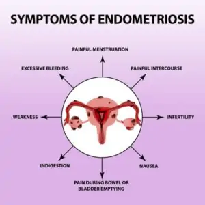 Illustrated diagram of endometriosis symptoms