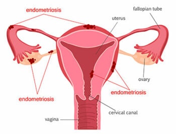 Labeled diagram of uterus and fallopian tubes with endometriosis