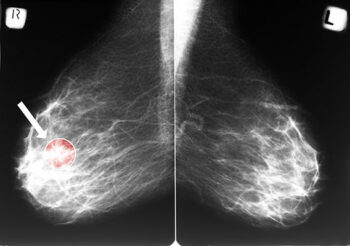 Mammogram image with cancer circled