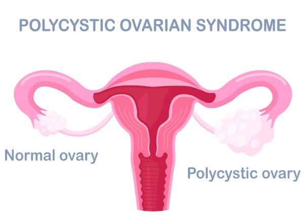 Infertility in Women