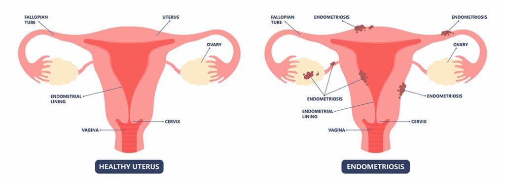 What does endometriosis look like?