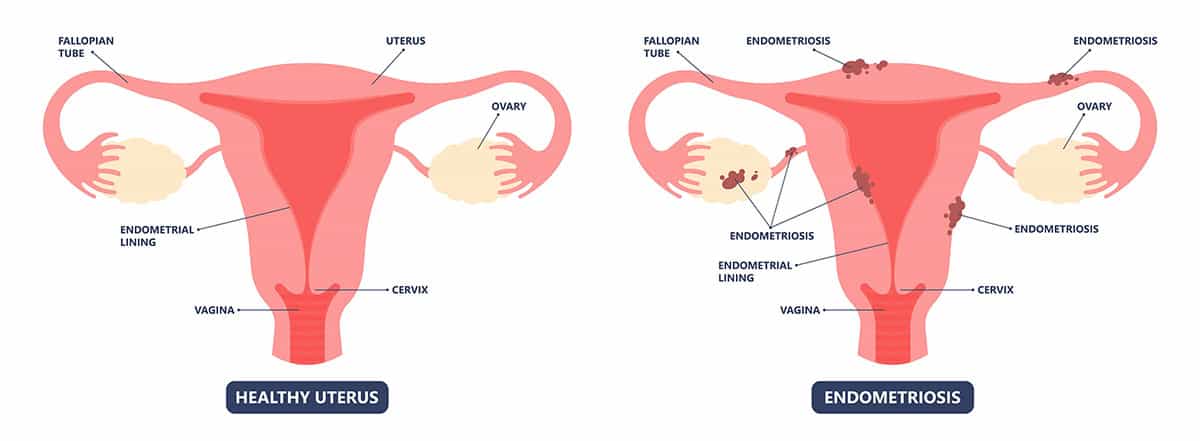 Normal Menstrual Cramps or Endometriosis: How to Tell the Difference:  OB-GYN Associates of Marietta: Obstetrics and Gynecologist