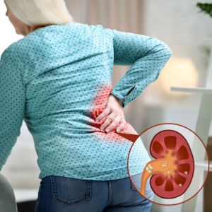 Pyelonephritis (Kidney Infection) 300x300