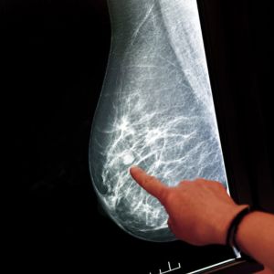 Breast Cancer Image 300x300