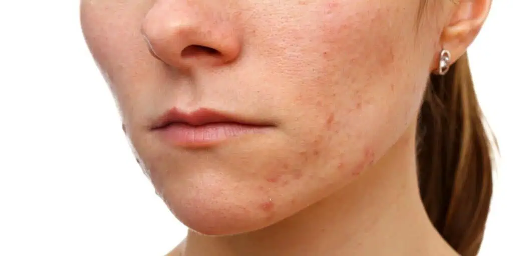 Hormonal Acne 