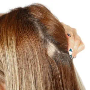 What are medical treatments for female hair loss