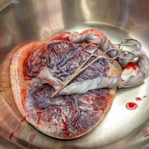 Placenta Accreta, Increta, and Percreta