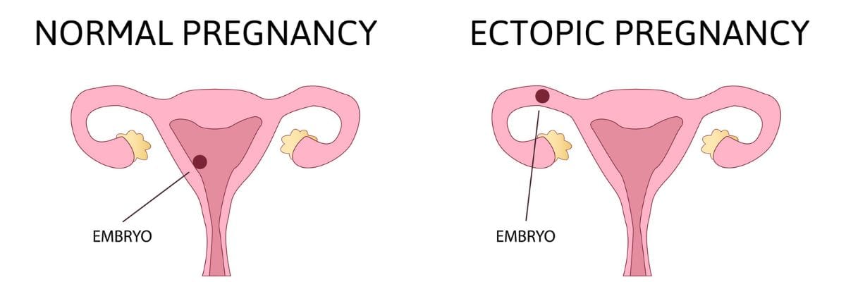 What is an Ectopic Pregnancy