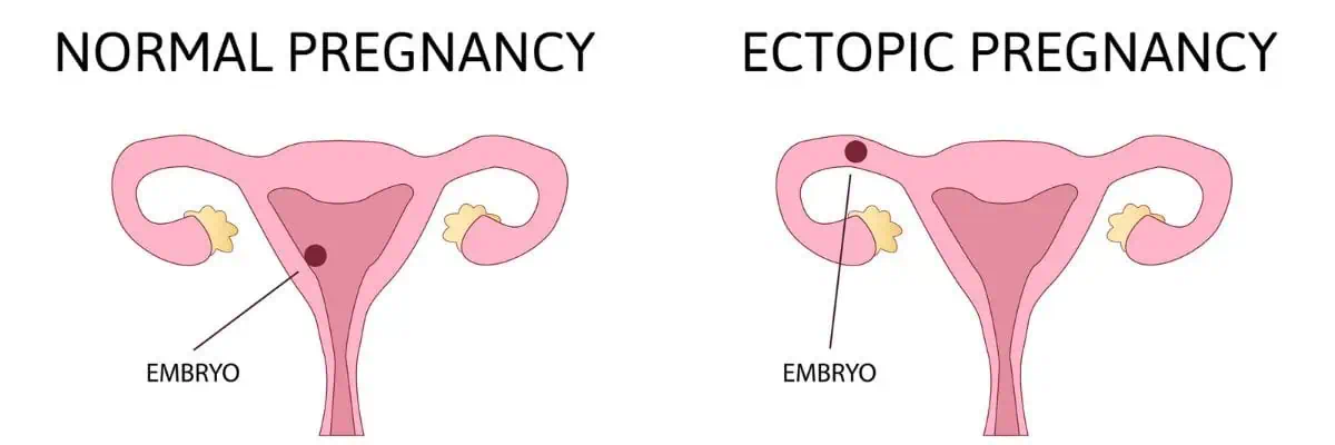 What is an Ectopic Pregnancy