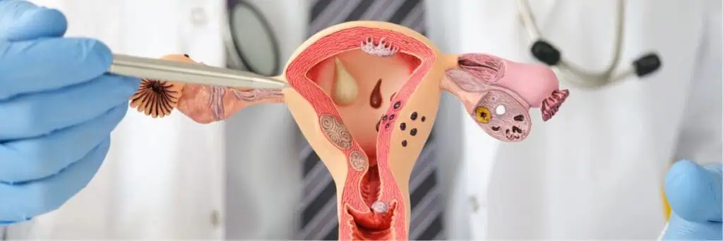 What is salpingitis?