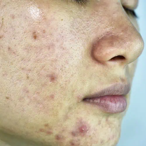 What the PMOS name change means for patients- skin condition