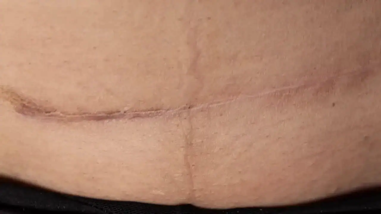 Close-up of a healed surgical scar on the abdomen by Dr. Thais Aliabadi MD.