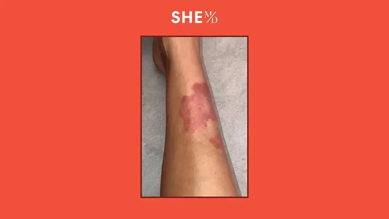 Close-up of a skin patch on an arm showing a skin condition treatment.