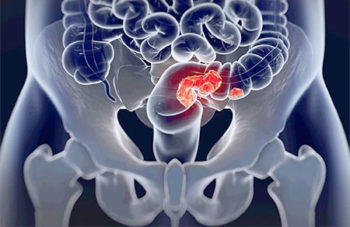 Colorectal cancer - Colorectal polyp